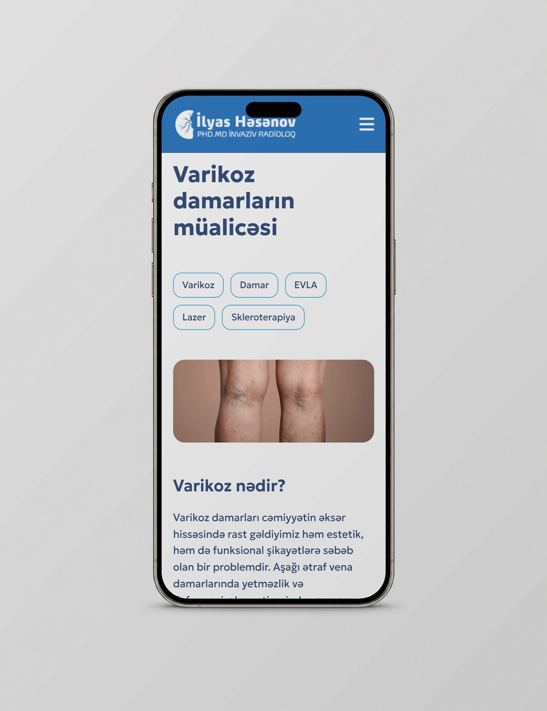 Dr. İlyas Həsənov — varicose veins page on a phone
